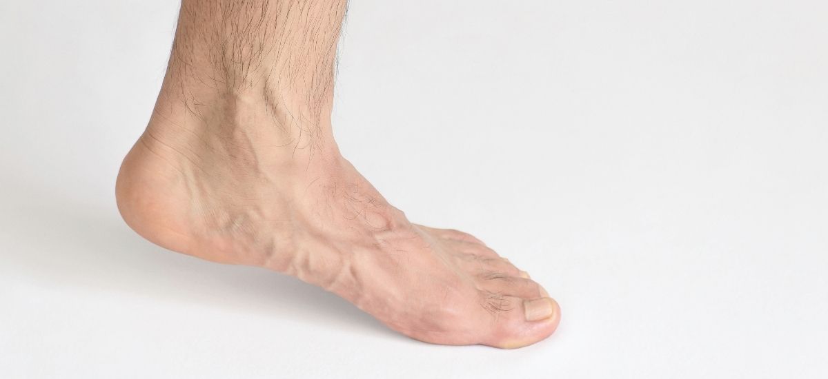 Posterior Tibial Tendon Dysfunction Treatment